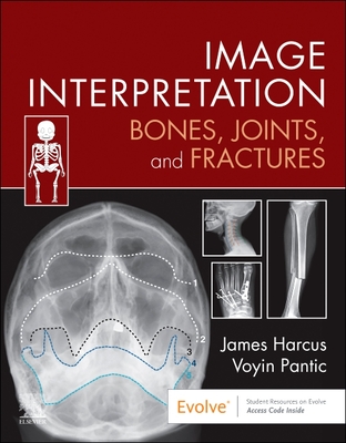 Image Interpretation: Bones, Joints, and Fractures (Harcus James)(Paperback)